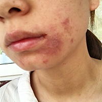 孕4个月，一直没怎么拍水乳，今天涂了点气垫，下午皮肤就成这样了，这是怎么了怎么了？有没有懂的美女呀？