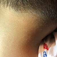 亲爱的宝妈们帮我看看，孩子今年四岁了春节发现孩子脖子后面长了些东西，去看了医生，医生说洗热水洗热...