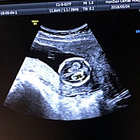 怀孕16周 4，今天做B超医生说胎儿脑子里长了麦粒囊肿（0.83*0.55cm），说看后期如果吸收了就没大碍，心...