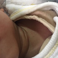 这些是不是湿疹啊…怎么办