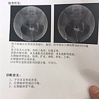 怎么办 输卵管堵塞了 有没有姐妹有什么好的土方法