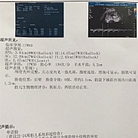 今天刚刚做的唐筛，谁有经验的看看这是小男生还是小女生呀！