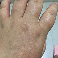 手上有白点，有时也会消失，这是怎么回事