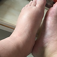 这脚肿的已经不能再肿了