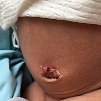 今天中午宝宝的肚脐自己掉了 周围有点发红。正常吗？需要怎么护理？