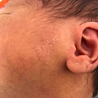 宝宝出生🐣就有，这几天一直在观察，是皮肤病还是胎记