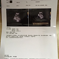 今天去B超检查，孕15周 ，帮帮忙看是男孩还是女孩