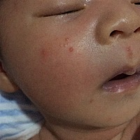 宝宝二十天，有谁知道这是不是湿疹？
