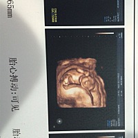 今天做了NT，宝宝一切正常。第一次当妈妈，好好奇是个男宝宝还是女宝宝。