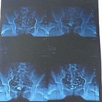 谁能看得懂，输卵管造影，严不严重？