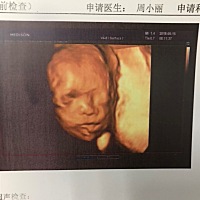 今天去做三维出来就觉得宝宝有点丑 不知道像谁 我老公还说丑得有点过分 人家说三维拍出来的宝宝都这样 ...