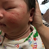 宝宝脸上长了这个一颗颗的   是奶藓吗？    感觉越长越多。。😭😭