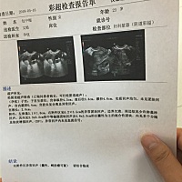 医生说囊肿，麻烦大家帮我看一下，谢谢