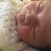 宝宝17天了，这几天脸上长了好多痘痘，是天气太热起的热痱子嘛。