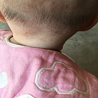 大家帮我看一下是不是血管瘤，一出生就有的。