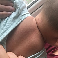 谁知道宝宝后背长的是痱子吗，