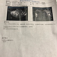 流产后的检查。当我就做完彩超后。医生已经下班了。我也看不懂。 有会看的姐妹们吗？帮我看看。  谢谢了...