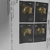 依家都未见胎芽又不知道有几周有心跳，真是担心啊，我以经2月份失去佐一个不想在失去啦