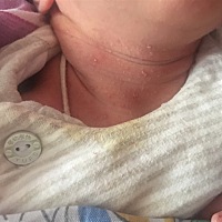 宝宝出生第7天，脸上，脖子上出现这种情况，求退去方法