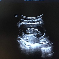 2018年4月19日 星期四下午 妈妈带你去做 nt 检查，一下午做了三次，干爹给你找好医生，你总是背对着妈妈...