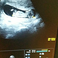 有会看B超单的吗，看下是男宝女宝，希望是男宝