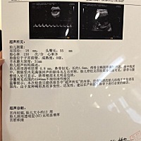 今天查的nt  就是孕囊周围有不规则液体暗区  请问孕妈们正常吗？？医生说的让我复查  真的有那么严重吗