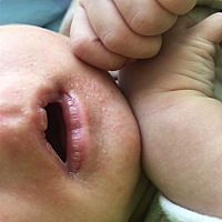 谁知道新生儿脸上和头皮上出的这个是什么啊？