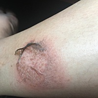 被摩托车排气管烫伤，用什么能收干，消炎啊……