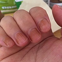 求大神指点：产前手麻，产后手仍发麻，指甲也变黄色！