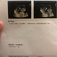 今天NT通过啦，紧张到不行，希望宝宝一直健康平安。姐妹们好运