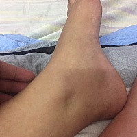 有孕妈脚水肿，按一下会凹进去这种情况么