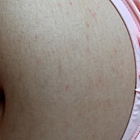 肚子上不知道从什么时候开始有小红点了，不疼不痒。现在宝宝19周。有一样的宝妈没？是不是正常的？