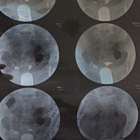 姐妹们有没有和我一样的？这样是不是只能做试管婴儿了