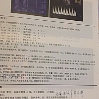 四维彩超显示胎儿是双向腔静脉，SD值增高，医生说让转三甲医院检查。有没有遇到类似情况的？好担心……