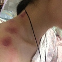 又中署了，还好姑婆和婶婶给我扭出来了^_^，老公扭不出，有没有人告诉我怎么改善这种爱中暑的体质，有没...