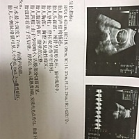 21周 今天检查，有脉络膜囊肿？到底要不要紧！好心塞……会看的帮我看看是男宝宝还是女宝？