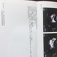 测排卵试纸，一直是一深一浅，今天去医院监测排卵啦，医生说快排啦