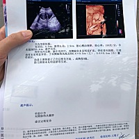 怀孕20周检查出双侧脉络丛囊肿，谁懂呀，麻烦说说，医生说大部分会在26周自行消失，建议做无创