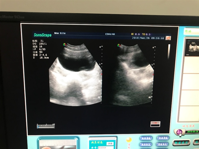 月经第十五天医生说排出了