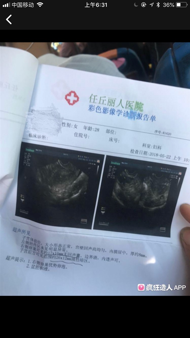 月经第十一天医生说这个卵泡不成熟