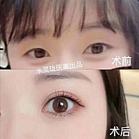 别小看眼皮那条线😑 多了，眼睛精致感➕10倍😍 对于瞳孔暴露度不足的人来说，除了精致感倍增，关键...