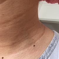 25周！脖子上长了很多小肉揪！不知道是啥！产后会不会掉啊！