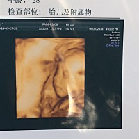 做完四维了，孩子一切都好，就是说球拍状胎盘，医生说有可能有危险，怕脐带脱落会导致孩子缺氧供血不足...