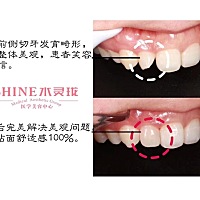 水灵珑医美口腔科全瓷贴面修复，这个夏天不仅要有一见倾心的眉眼，还要有笑得灿烂的美牙噢❤️