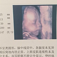 四维彩超 跟哥哥很像啊