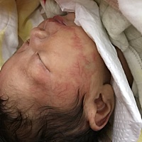 宝宝脸上有血管瘤，谁能帮我出点主意