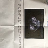 12周NT检查，正常吗