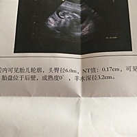 Nt结果，很好奇是男孩，还是女孩，有会看的吗