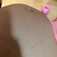 怀孕19周了，肚子算不算大。体重猛长。还感觉不到胎动。好期待宝宝动。今天突然长这个了。医生说是湿疹...