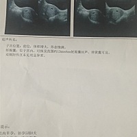 怀孕以后第一次做b超